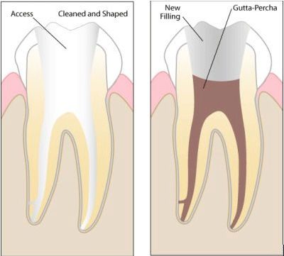 Root Canal Treatment 