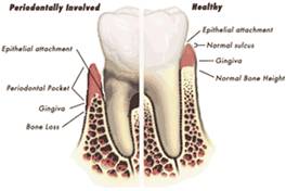 Periodontal Therapy