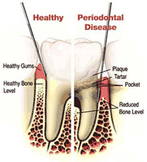 Periodontal Therapy